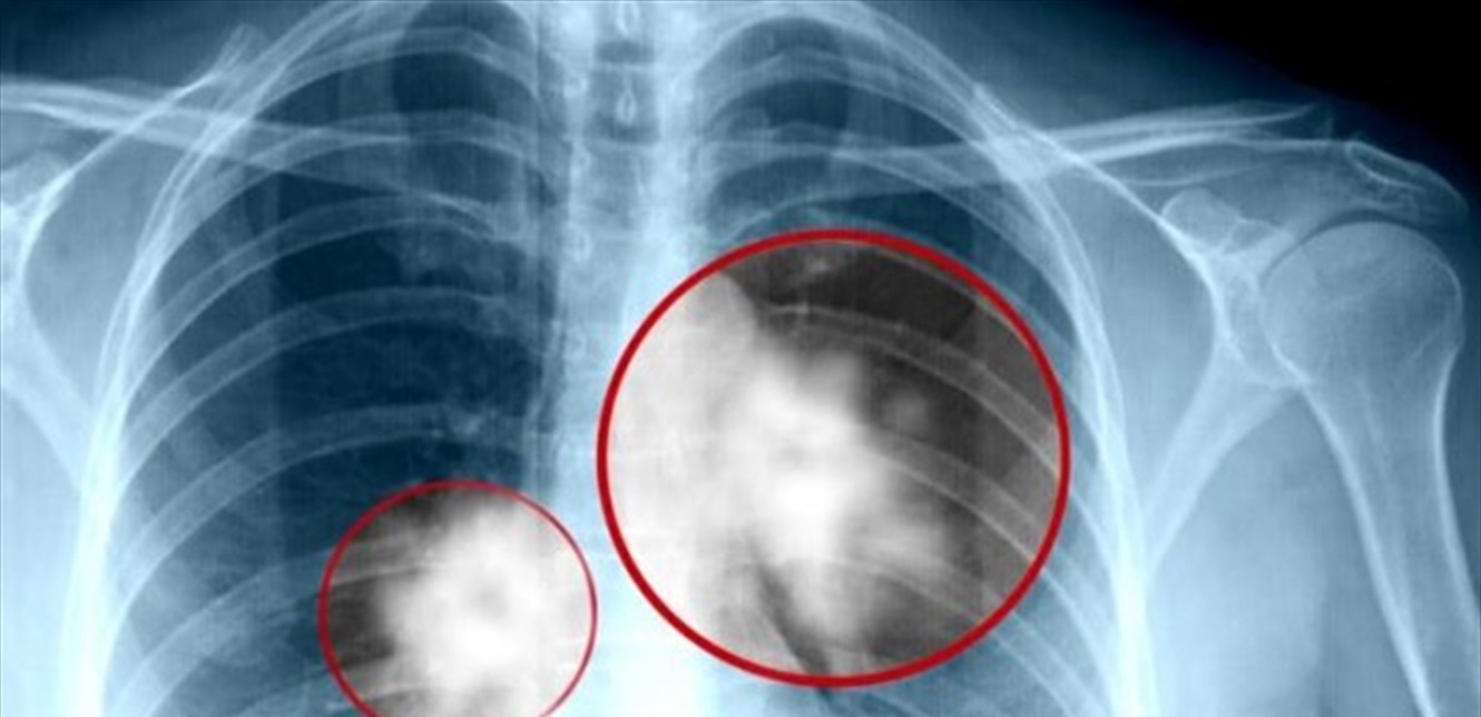 5 Key Indicators You Should Not Overlook of Lung Cancer!