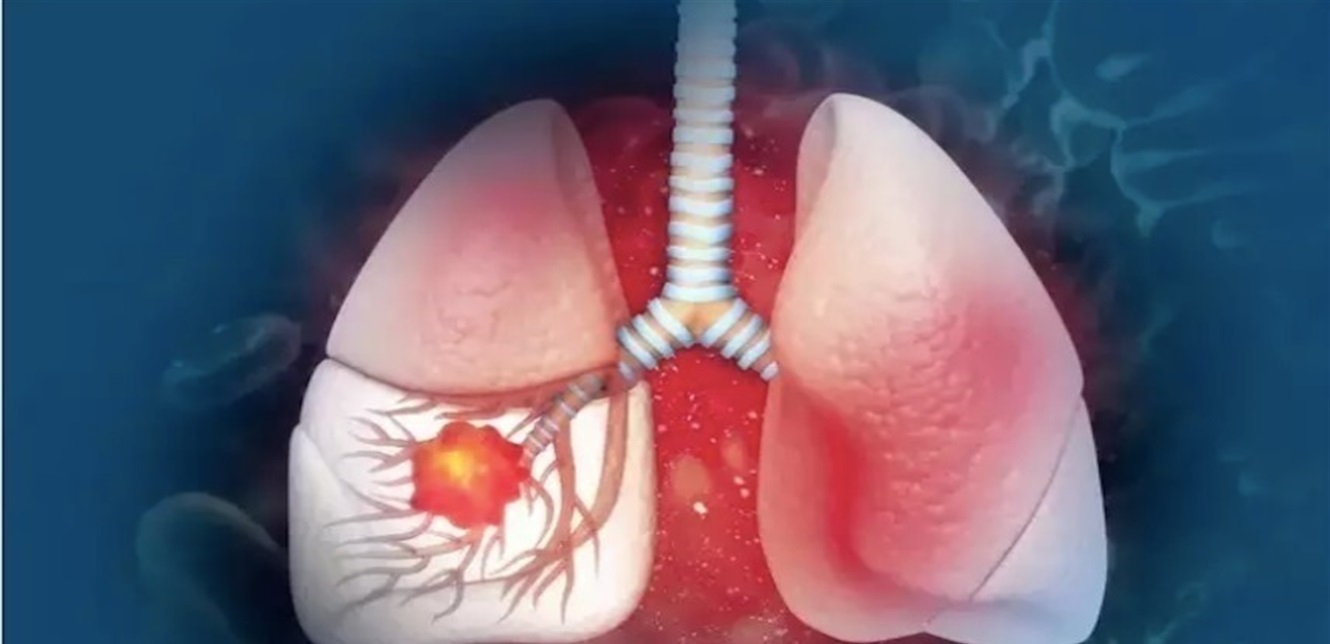 “Four warning signs of lung cancer that appear in the morning”