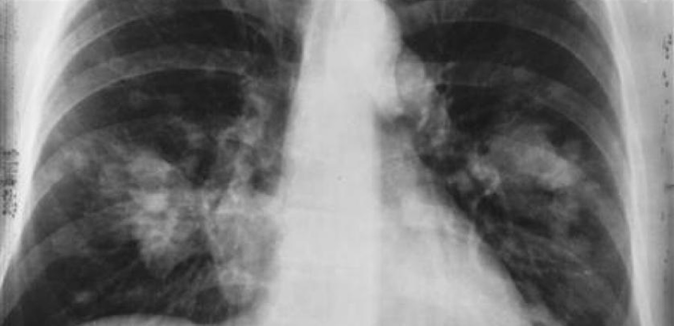 5-signs-that-you-may-have-lung-cancer-archyde