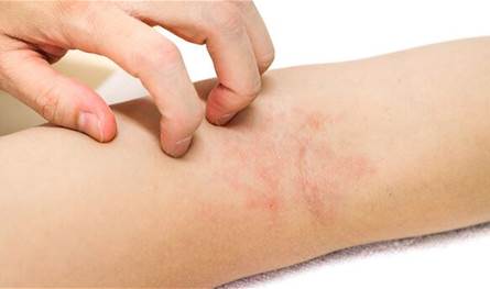 علاج احمرار الجلد والحكة الشديدة بسبب ارتفاع درجات الحرارة